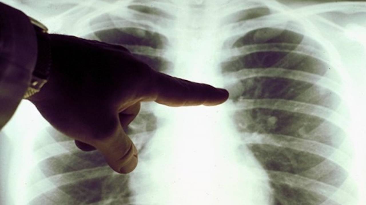 100 человек заболели пневмонией за сутки в Казахстане 