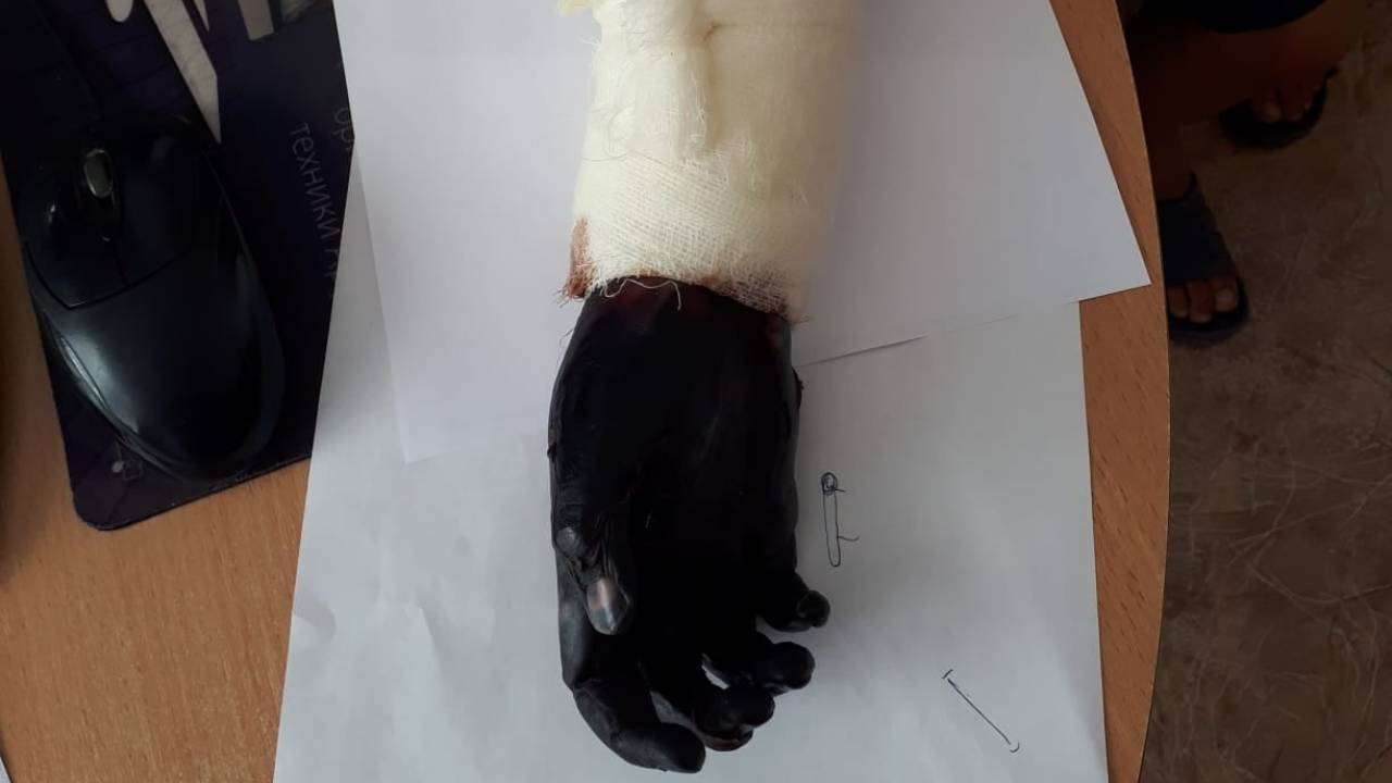 Мальчик лишился руки после лечения "целителя" в Мангыстауской области